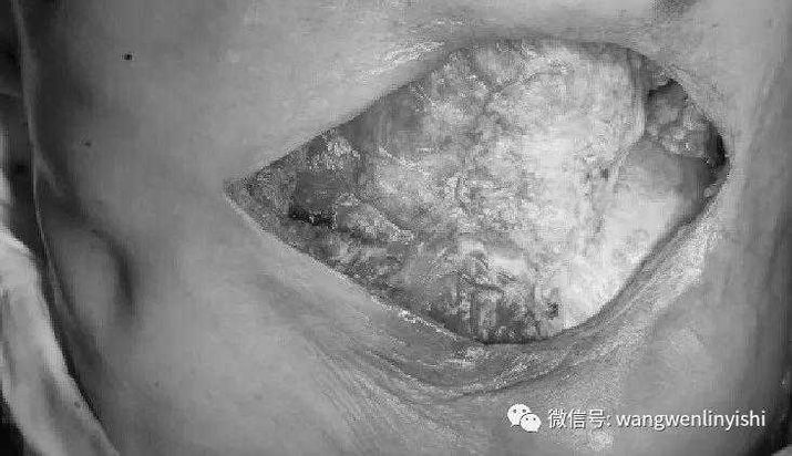 Matrix RIB修复胸壁缺损