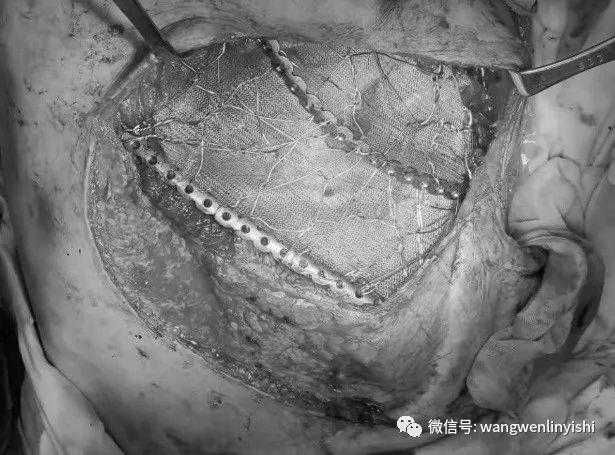 手术结束