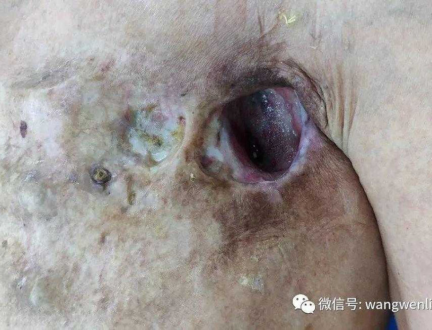 左侧前胸壁缺损