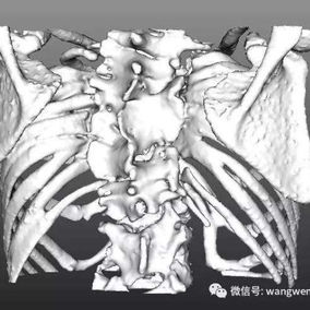 三维图像显示脊柱病变明显