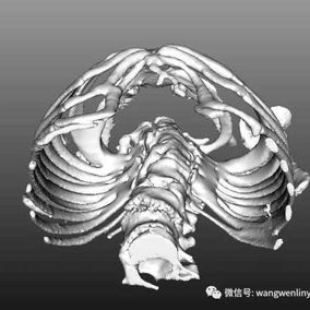 三维图像显示前胸壁前突，脊柱生理弯曲消失