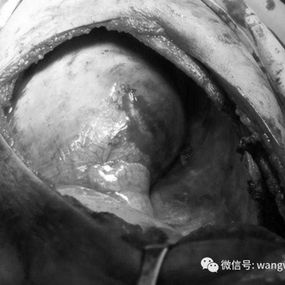 右侧胸壁肿瘤切除后胸壁的巨大缺损，可见右侧膈肌及肺组织