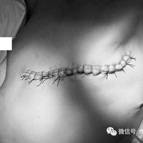 手术完成