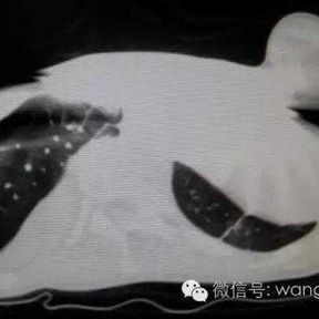 CT截面图提示左侧前胸壁畸形凸起，心脏受压明显