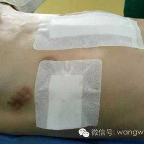 术后胸廓侧面观，外表已恢复基本的形状，凸起消失，凹陷消失