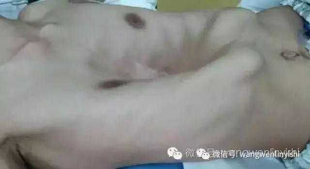 术前重度畸形外观