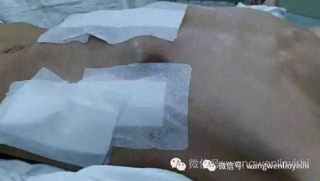 术后胸壁外观基本正常