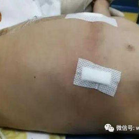 术后胸壁外观