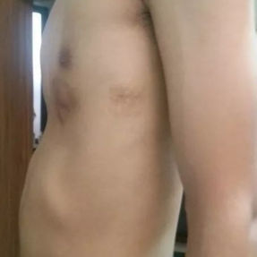 典型的沟状凹陷，左侧胸壁可见一处陈旧性手术疤痕