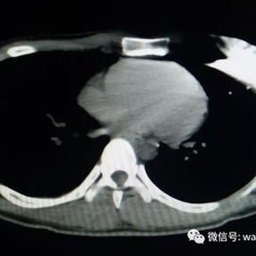 CT显示左侧胸壁钢板固定处