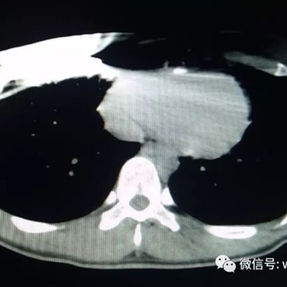 CT显示右侧胸壁钢板固定处
