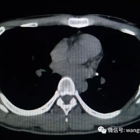 CT显示钢板融入胸壁软组织