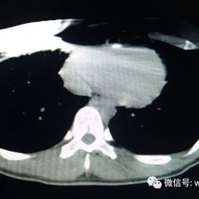 CT图显示钢板两端融入软组织