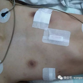 术后胸壁恢复正常形状