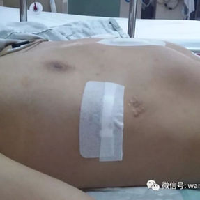 术后胸壁畸形消失