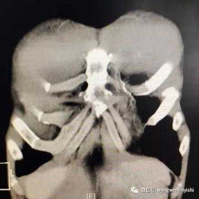 CT检查冠状面显示沟状凹陷的位置