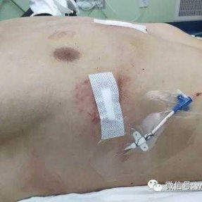 术后畸形完全消失