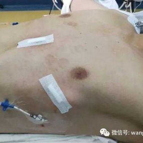 术后胸廓外观恢复正常