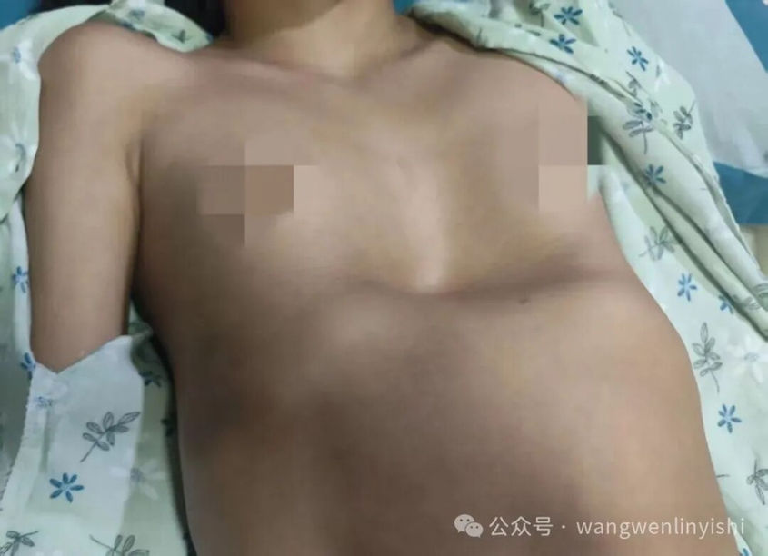 重度不对称型凹陷畸形