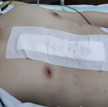 术后畸形消失