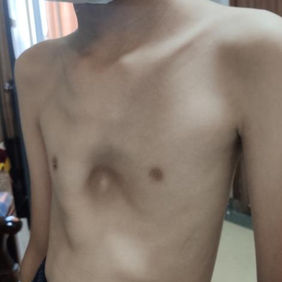前胸壁重度凹陷，右侧边缘呈嵴状隆起