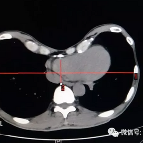 CT检查，前胸壁凹陷严重，Haller指数5.6
