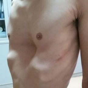 术前胸壁外观
