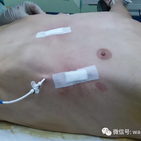 术后胸廓畸形完全消失