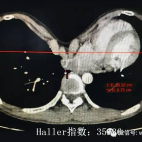 典型的漏斗胸征象