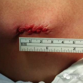 术中切口长2.5cm