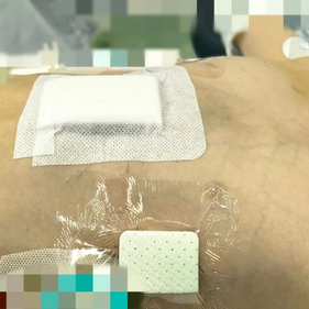 术后患者的胸廓恢复正常形态