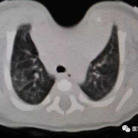 CT检查：前胸壁正中骨性结构消失