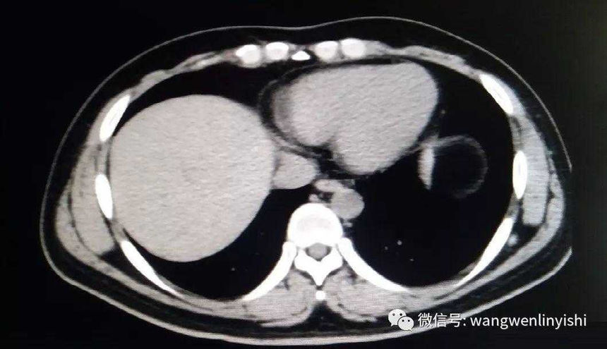 CT检查：下半胸壁凹陷