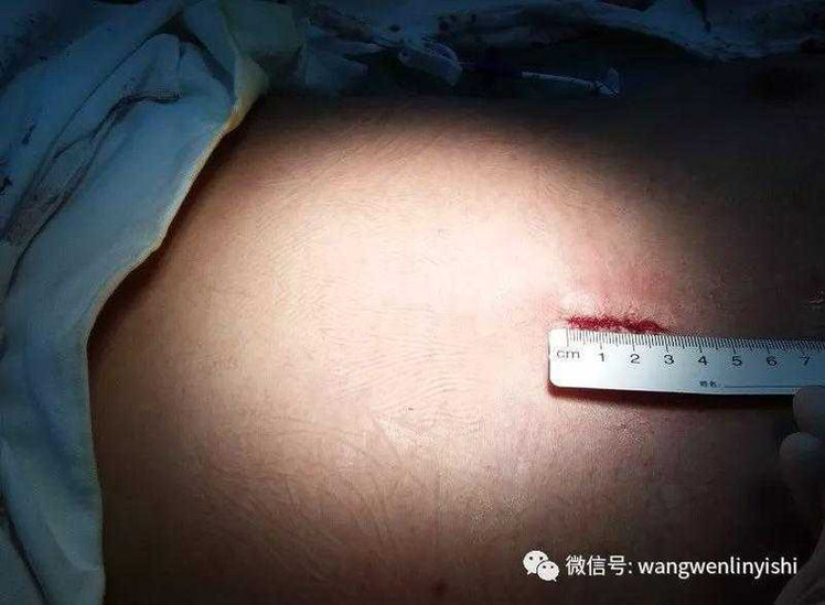 正中切口，长3cm
