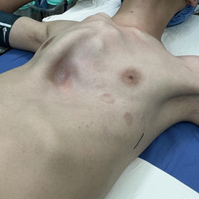 术前患者胸壁外观