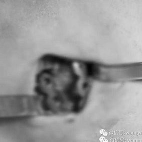手术切口