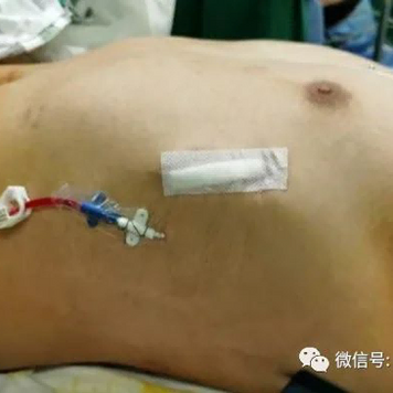 术后胸壁外观
