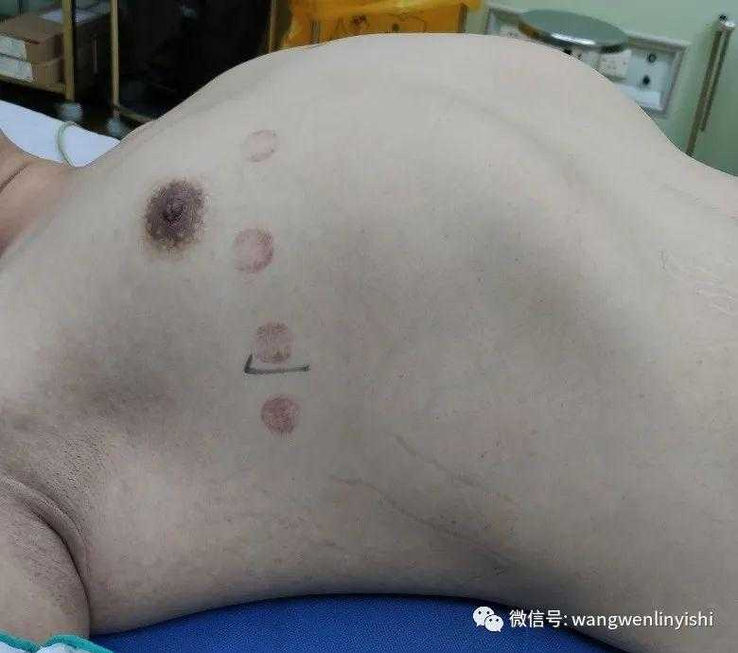 前胸壁严重前突，整体外观为桶状