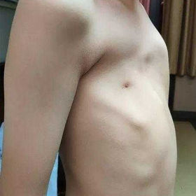 术前胸壁外观