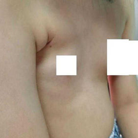 前胸壁左右不对称，右侧明显凹陷，乳腺和胸大肌发育不良