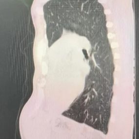 前胸壁畸形严重，心脏受压明显