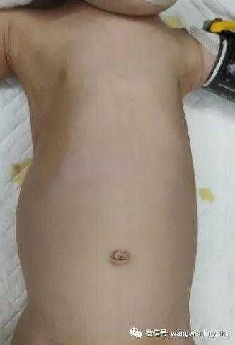 前胸壁整体前突，两侧凹陷