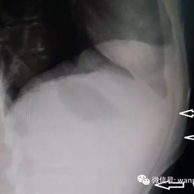 侧位X线片：A、B为肋弓前突征象，C为凹陷征象