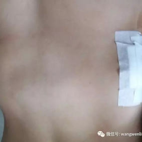 术后胸廓外观