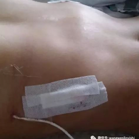 术后胸廓外观