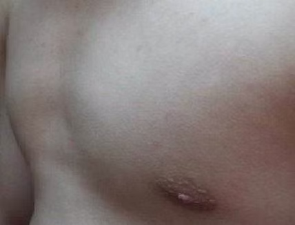 30岁男性鞍状胸患者的微创手术