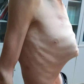前胸壁严重前凸