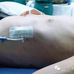 术后畸形彻底消失，外观恢复正常