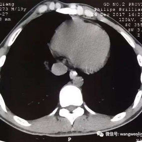 术前CT检查：提示前胸壁严重前突