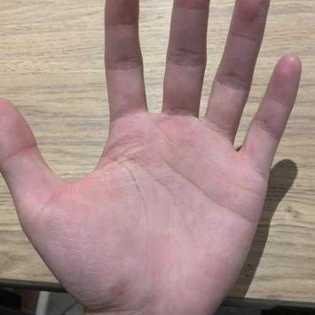 手术后，患者手汗已消失